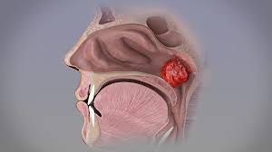 Adenoid anatomy